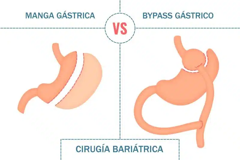 diferencia entre manga gástrica y bypass